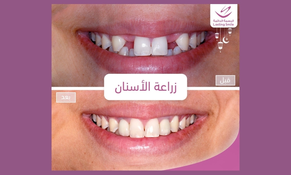 حالة تصميم ابتسامة هوليوود بالفينير الخزفي