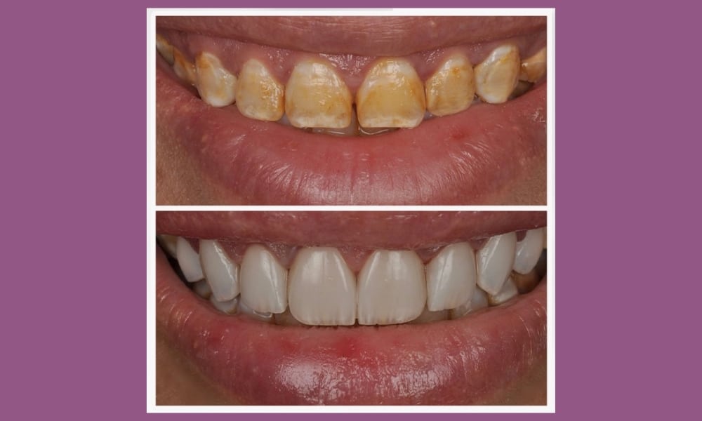 حالة تعديل عضة الفك والتقويم الوظيفي